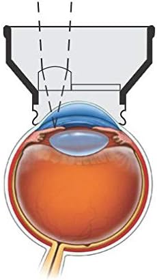 Lente de iridectomia da YAG Opticlear para procedimentos de iridectomia a laser